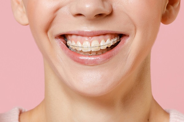 What Are Clear Braces?