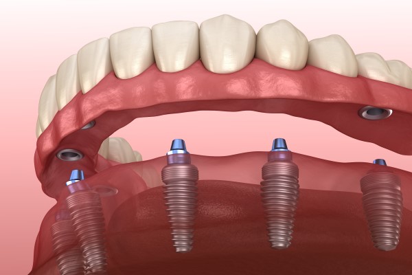 Common Questions About Implant Supported Dentures